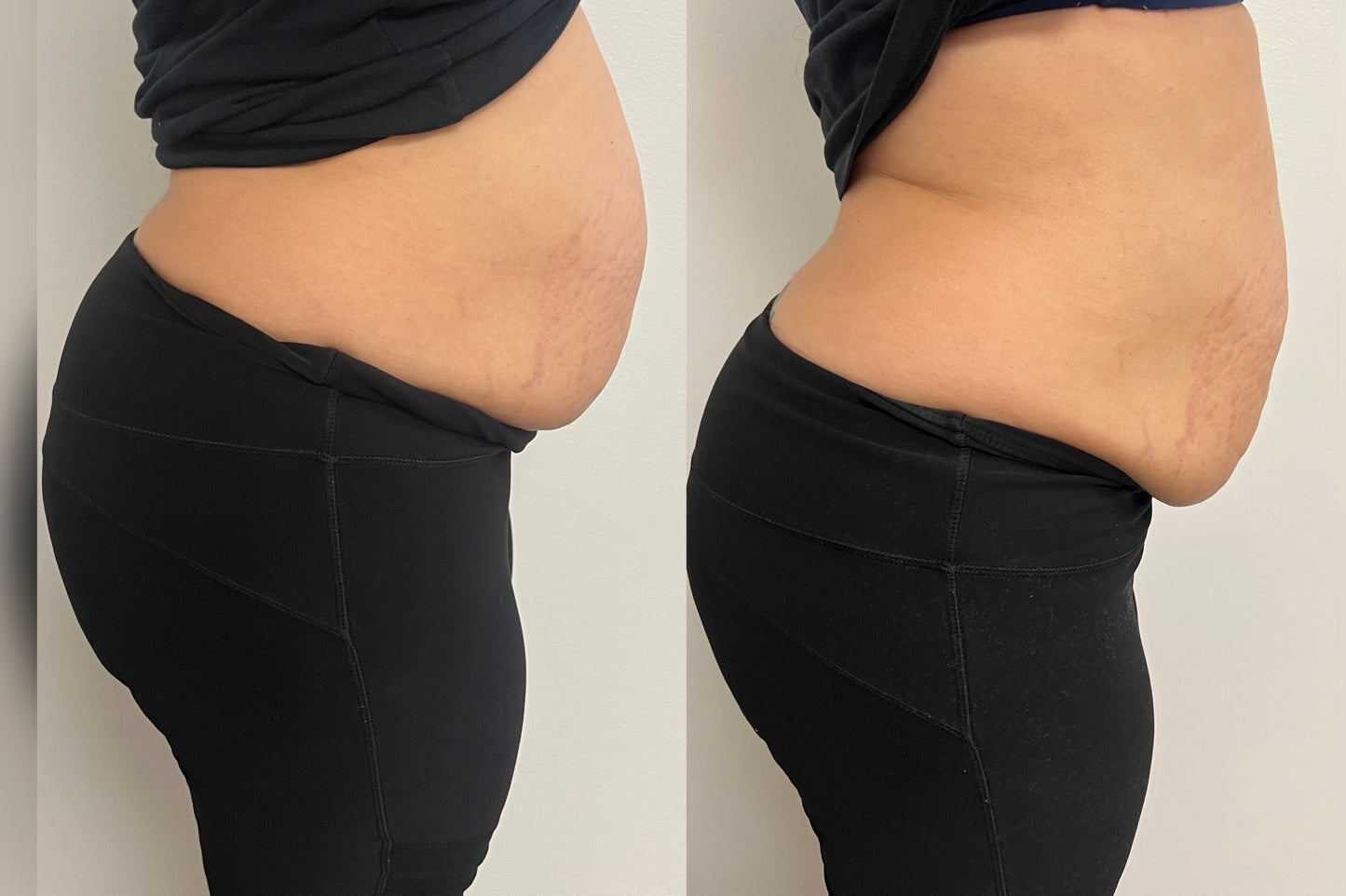 1 Hour Tummy Tuck Package of 5