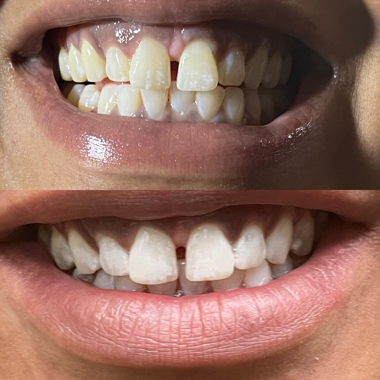 Luxe White - 30 minute teeth whitening session